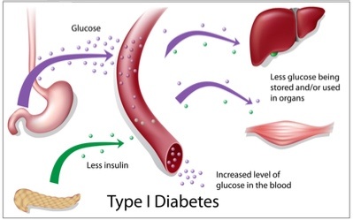 diabetes tipe1