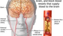plak dalam pembuluh penyebab stroke