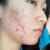 jerawat