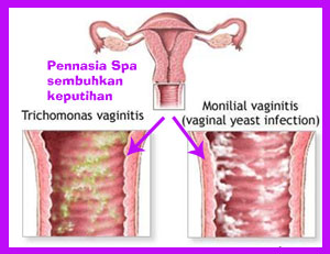 keputihan