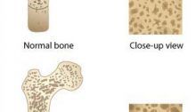 osteoporosis