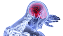 penyakit stroke
