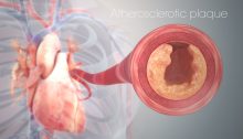 Pembuluh darah arteri yang tersumbat