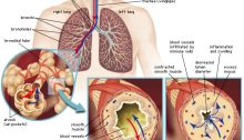 Asma asthma